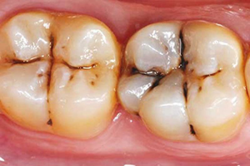 ۳۰۰ میلیون دندان پوسیده در دهان ایرانیان 